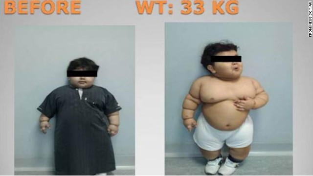 Obese 2 Year Old Has Weight Loss Surgery How Young Is Too