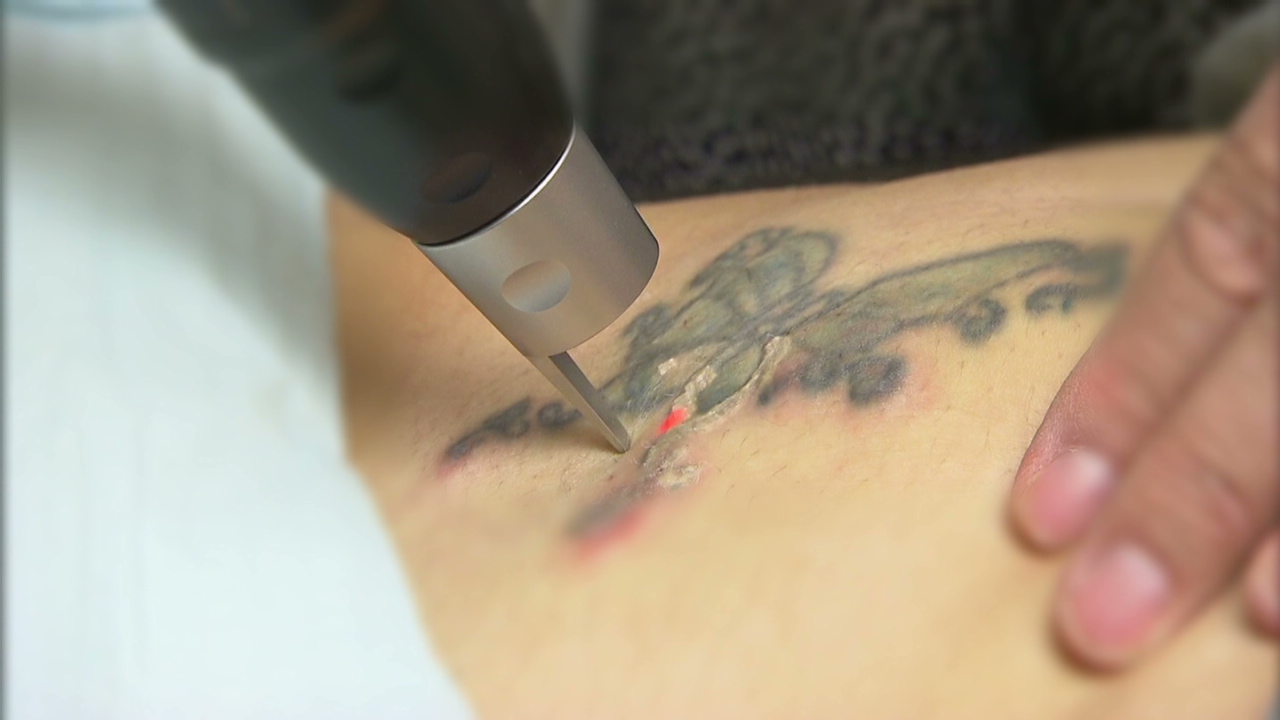 Improvements In Tattoo Removal Cnn Video