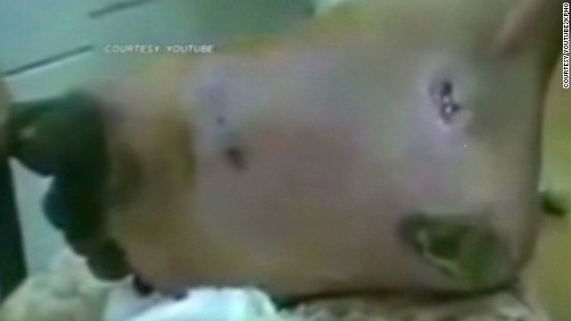 Krokodil Flesh Killing Drug Used In U S Cnn Video