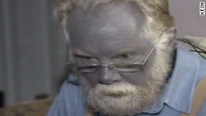 Why this man's skin turned blue