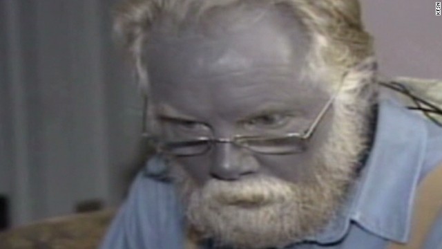 Strange case of Paul Karason who turned himself blue due to colloidal silver