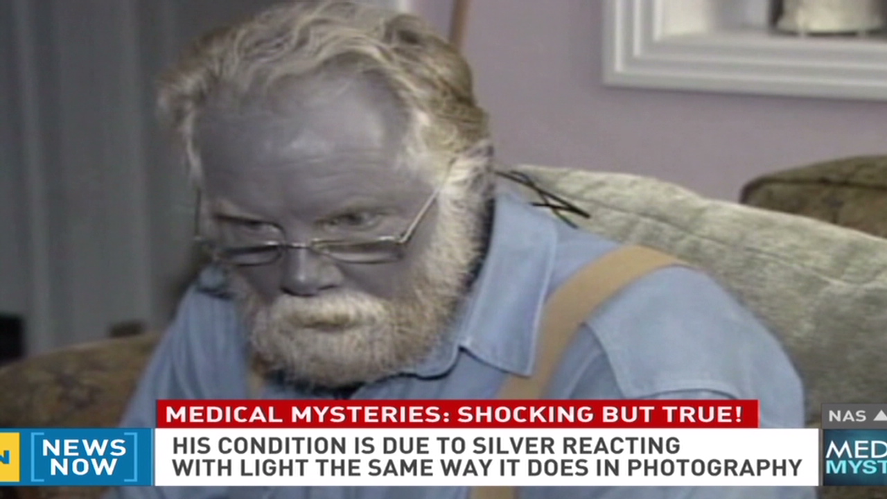 Strange case of Paul Karason who turned himself blue due to colloidal silver