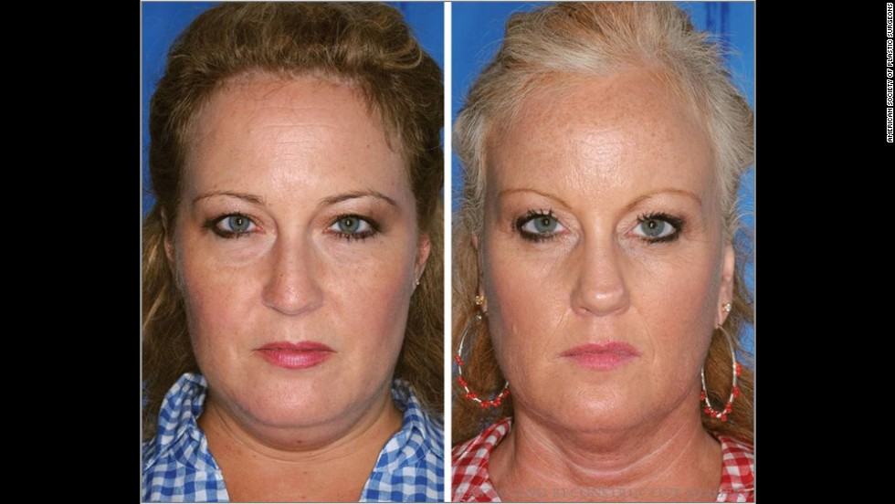 The twin on the right is a smoker; the twin on the left is a nonsmoker. Note the differences in the lines between the nose and mouth.