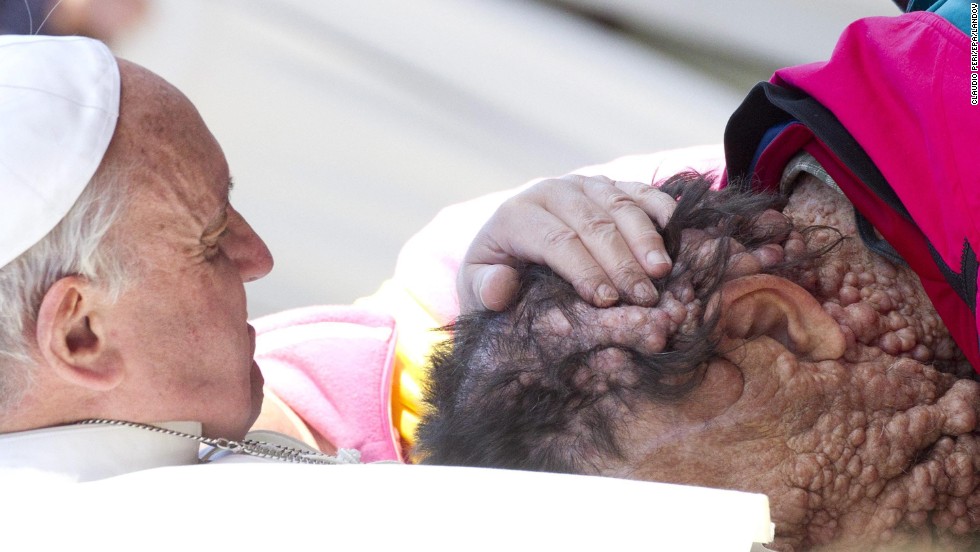 Pope Francis embraced Vinicio Riva, a man with a rare skin disease, in November. The images went viral, with even atheists expressing admiration for the gesture.  
