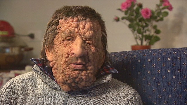 Meet the disfigured man the Pope kissed