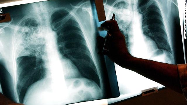 Tuberculosis (TB) Fast Facts