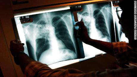 New treatment approved for drug-resistant tuberculosis