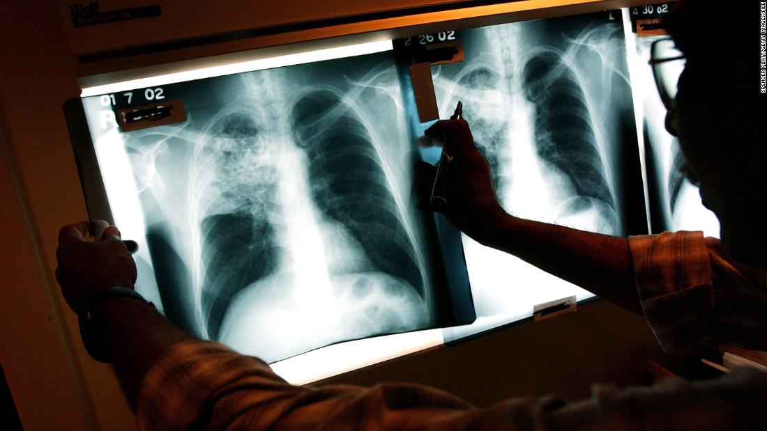 US tuberculosis cases nearing pre-pandemic levels, CDC data shows