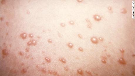 Shingles vaccine side effects mostly mild, CDC says - CNN