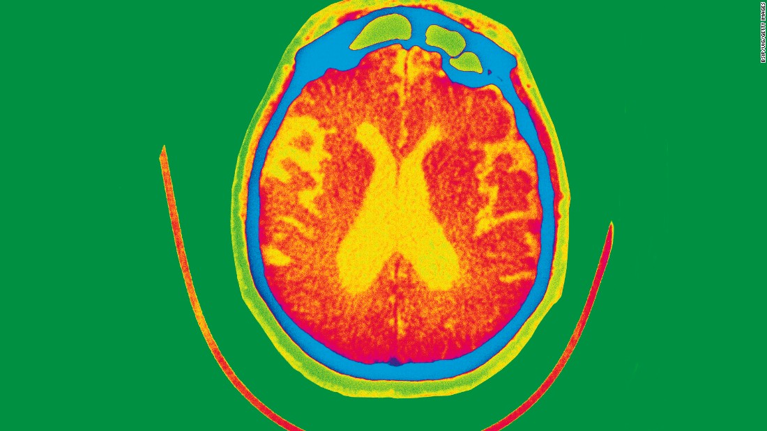 Experimental therapy gantenerumab fails to slow or improve Alzheimer's memory loss in clinical trials