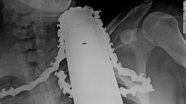 Man Survives Chainsaw Stuck In Neck