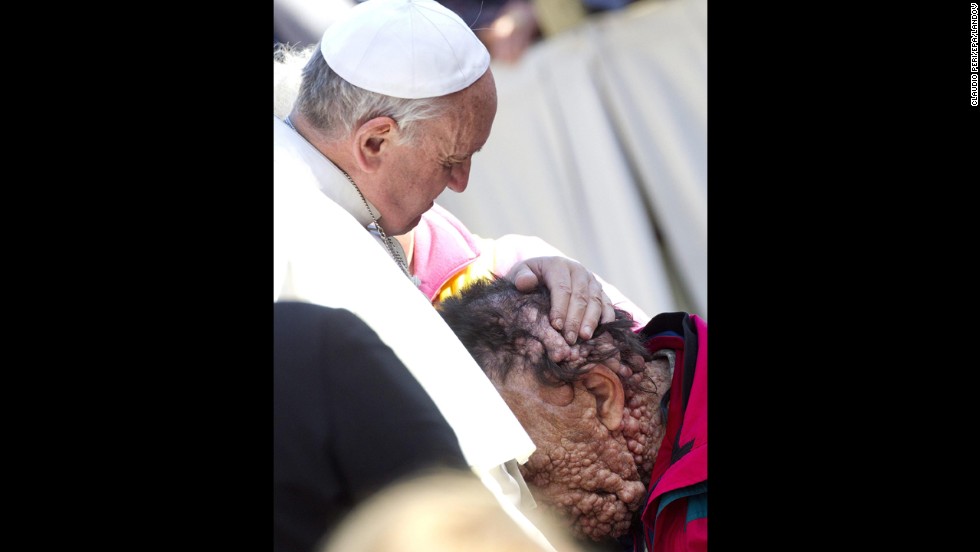Pope Francis embraced Vinicio Riva, a disfigured man who suffers from a non-infectious genetic disease, during a public audience at the Vatican in November 2013. Riva then buried his head in the Pope&#39;s chest.