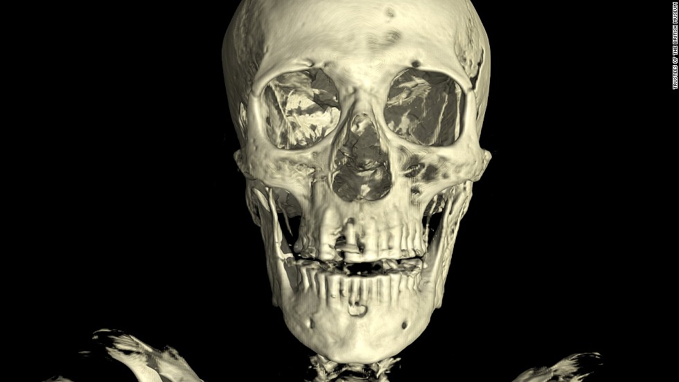 The scan of the unknown man revealed evidence of dental abbesses and the loss of several teeth, which would have meant he likely was in severe pain in the lead up to his death.