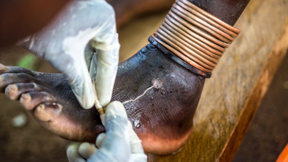 South Sudan goes 15 months without a case of Guinea worm - CNN