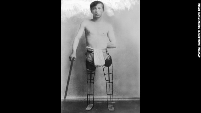 The &#39;bionic men&#39; of World War I