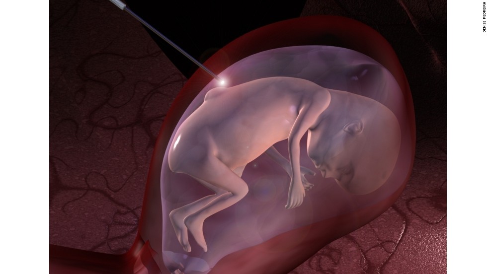Researchers are developing a three-armed robot to perform keyhole surgery to correct congenital defects on babies in the womb.