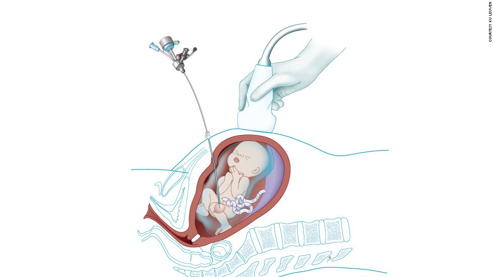 It could also be used to access a baby&#39;s bladder to treat fetal lower urinary tract obstruction -- where babies are unable to urinate in the womb and their bladders become distended.