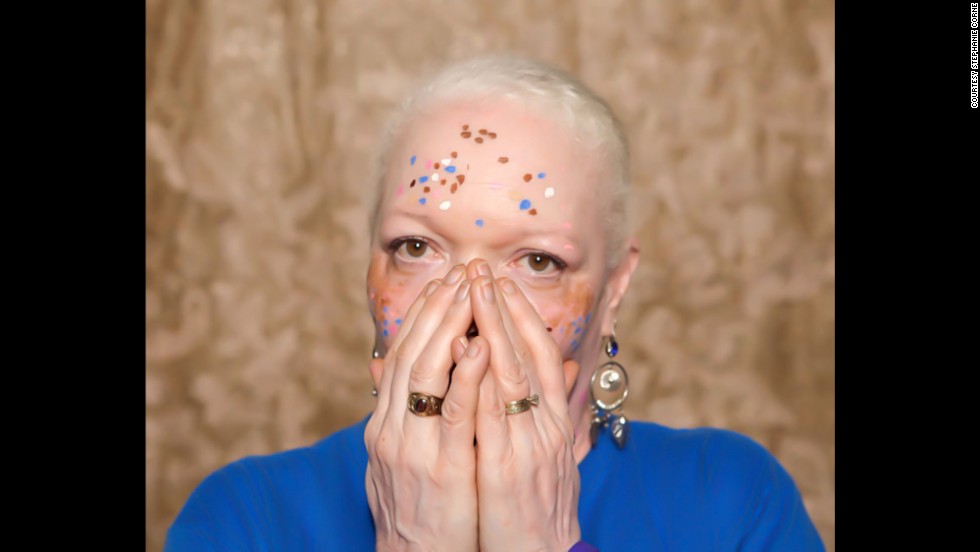 Vitiligo affects roughly 100 million people worldwide, according to the &lt;a href=&quot;http://vrfoundation.org/&quot; target=&quot;_blank&quot;&gt;Vitiligo Research Foundation&lt;/a&gt;. Pictured, Teri Martin.