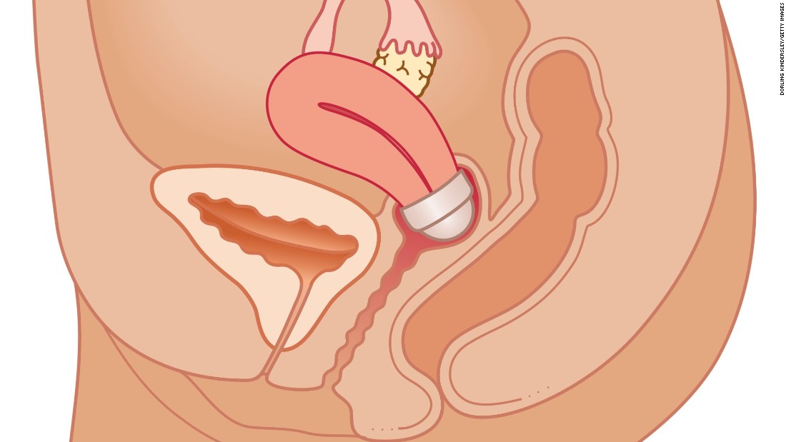 The cervical cap is similar to a diaphragm but smaller in size and made of rubber instead of silicone. It is useful for women who find it hard to keep a diaphragm in place. 