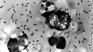 Every year, between 1,000 to 2,000 people get the plague -- including about 7 in the US