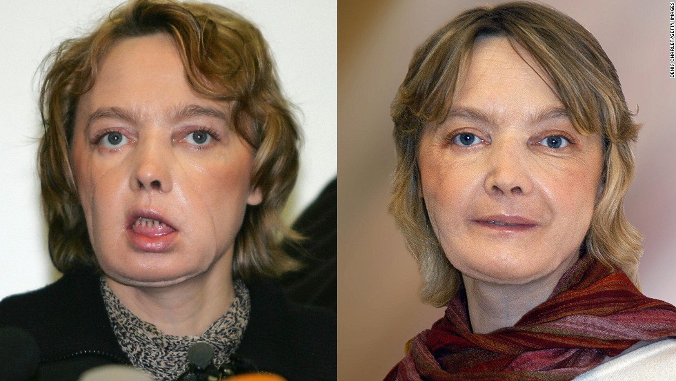 140724160837 Frenach Face Transplant Horizontal Large Gallery 