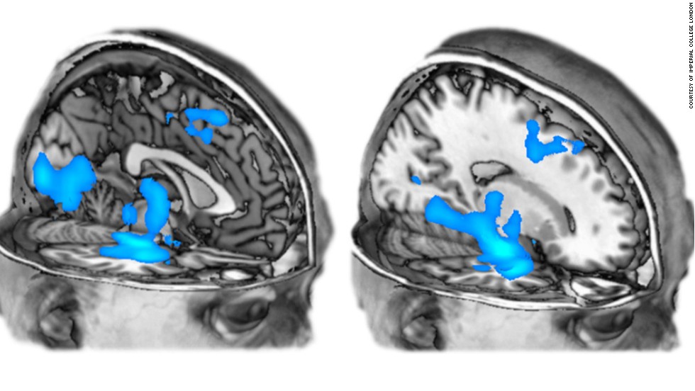 Researchers at Imperial College London also previously scanned the brain to see the effects of MDMA. Their findings hint that the drug might be useful in the treatment of anxiety and post-traumatic stress disorder.