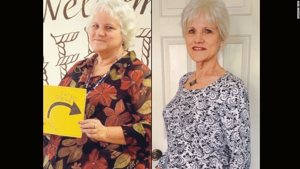 Kathy Kirby from Temecula, California, lost 136 pounds.