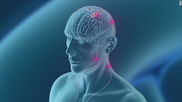 How deep brain stimulation could unlock secrets of Tourette's