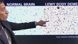 What is Lewy body dementia?