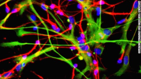 Stem cell study for ALS patients shows promise, yet causes pain