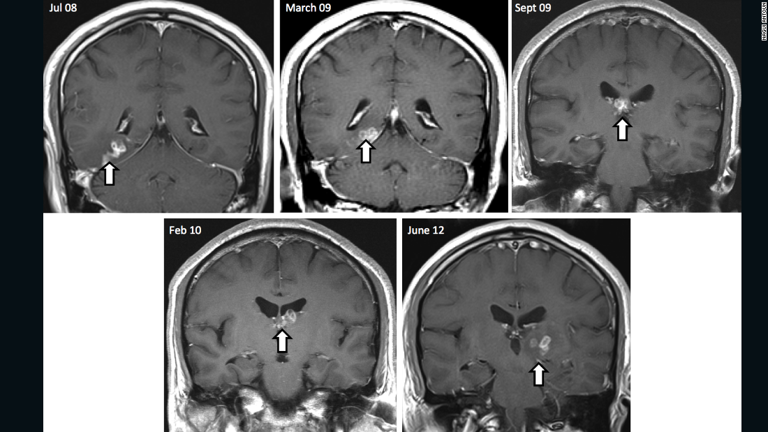 After four years, the British patient returned to hospital in pain to find his brain lesion had migrated to a new region of the brain resulting in new symptoms, including seizures. His MRI scans show the tapeworm&#39;s burrowed migration through the brain over four years.
