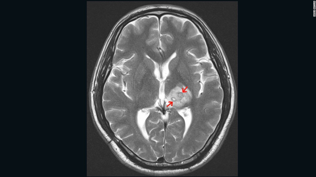 In 2013 a British man of Chinese ethnicity was diagnosed with a tapeworm, &lt;em&gt;Spirometra erinaceieuropaei,&lt;/em&gt; inside his brain. The 50-year old first experienced headaches four years earlier and was treated for tuberculosis. The arrows point to the mass created by the worm in his brain.