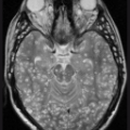 brain worm neurocysticercosis