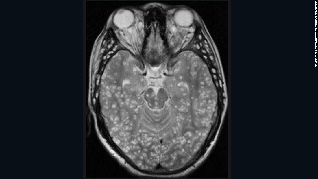 ... but infection with the worms&#39; juvenile (larval) form has worse consequences as the younger worms can migrate to other parts of the body. If they enter the nervous system the worms can form cysts in the brain, which have severe consequences, including epilepsy. In the radiology image above, the cysts are identified as white lumps within the brain.