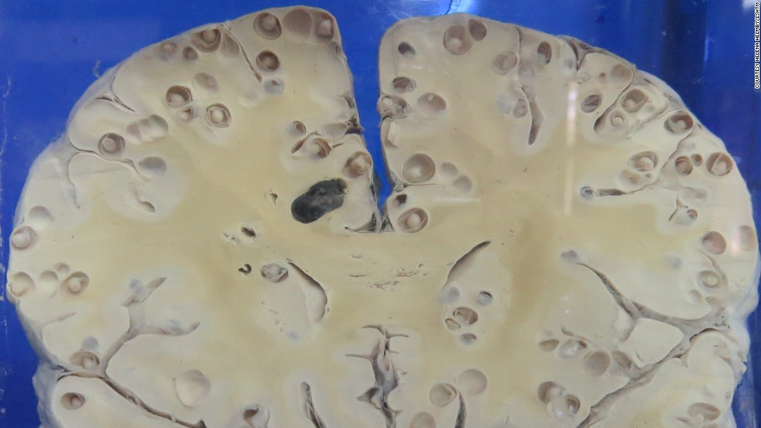 The young larvael forms of Taenia solium can migrate to the brain where they burrow to form cysts. This is a brain specimen of a patient in China with the resulting condition, known as neurocysticercosis.