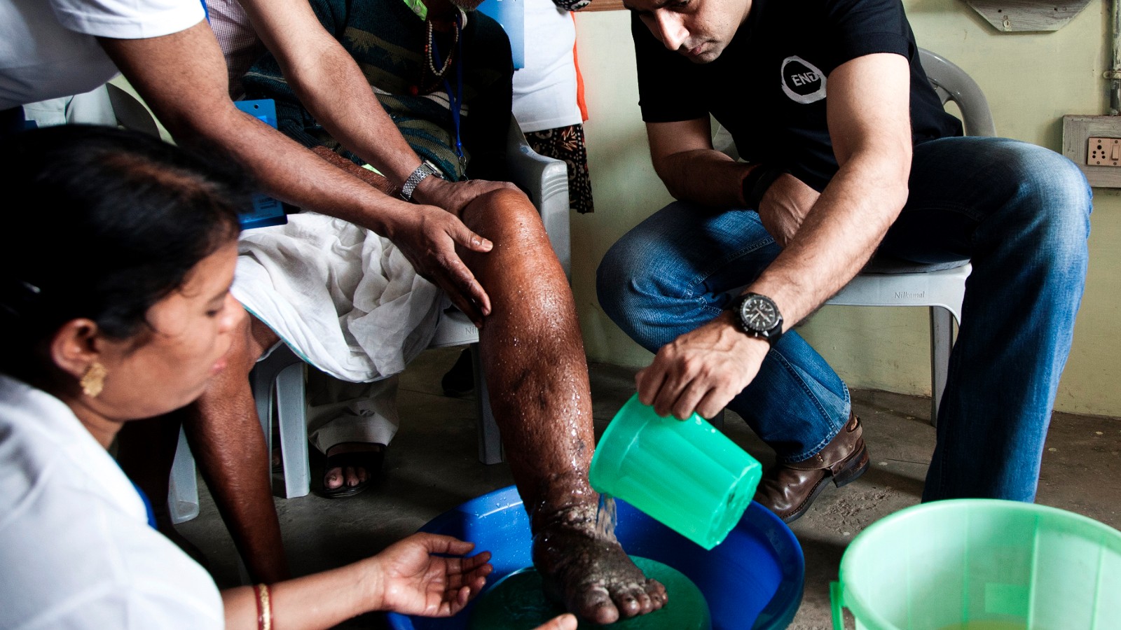 Every last worm: Eliminating Elephantiasis in India - CNN