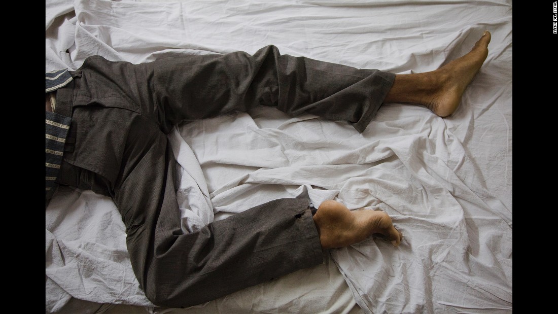 Dharmender lies on a bed in St. Stephen&#39;s Hospital a few days before his surgery. Even though his village was poor, his family took good care of him, del Estal said.