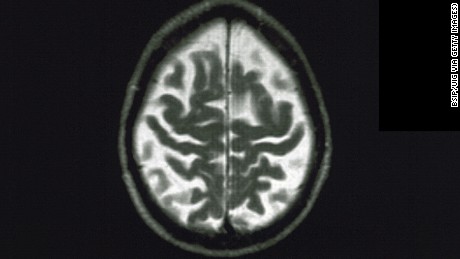 A brain affected by Alzheimer&#39;s Disease.