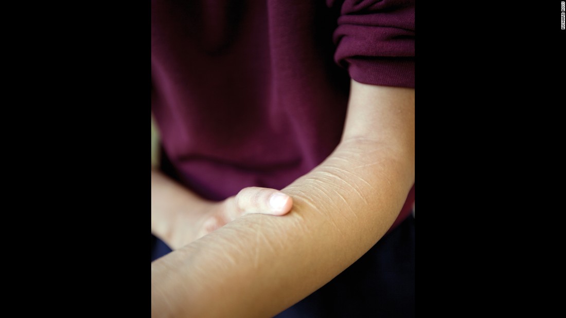 B.E., 17, shows marks on her arms. She told Ross that she and her sister were sexually assaulted by her father. &quot;I haven&#39;t cut in years,&quot; she said.