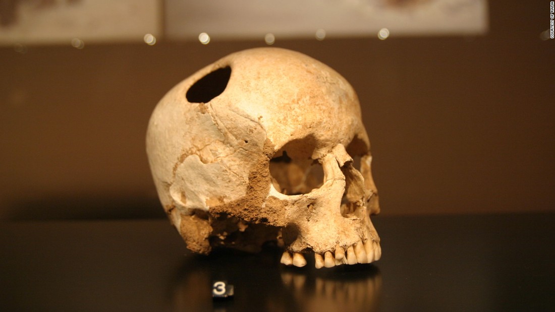 Trepanation -- the practice of cutting a hole in the skull -- was performed using obsidian tools by Neolithic cultures, although its purpose remains unknown. This skull in Lausanne Museum, in France, shows signs of bone regrowth, meaning the patient survived the operation.