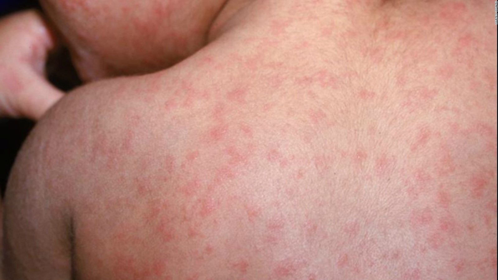 Why New York hasn't contained the largest and longest measles outbreak