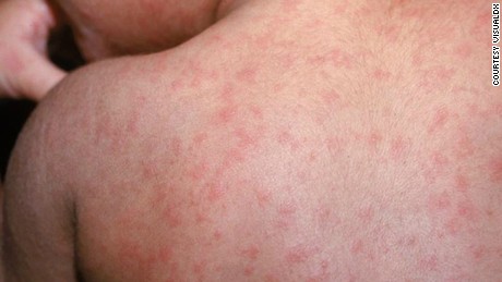 Measles accelerates to second-highest level in US in 25 years and over 100,000 global cases