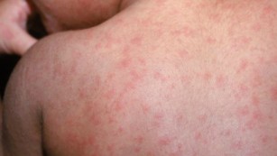 78 new measles cases reported nationwide since last week, CDC says