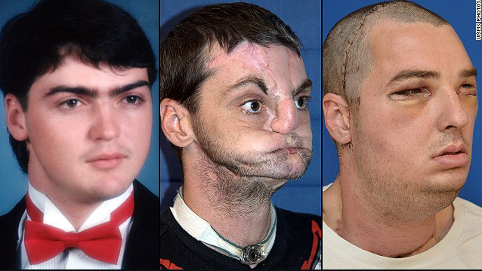 Deformities severe facial 10 Physical