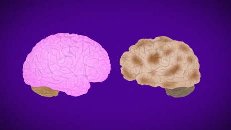 Quick facts about Alzheimer's disease