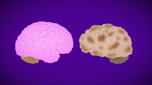 Alzheimer's Disease Fast Facts