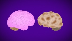 How Alzheimer&#39;s destroys the brain