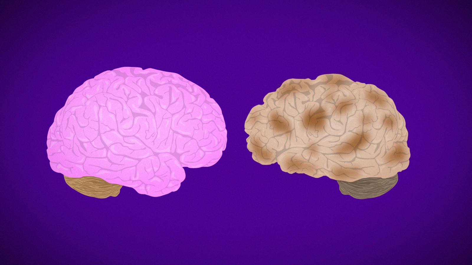 The fight against Alzheimer’s: Where are we now?