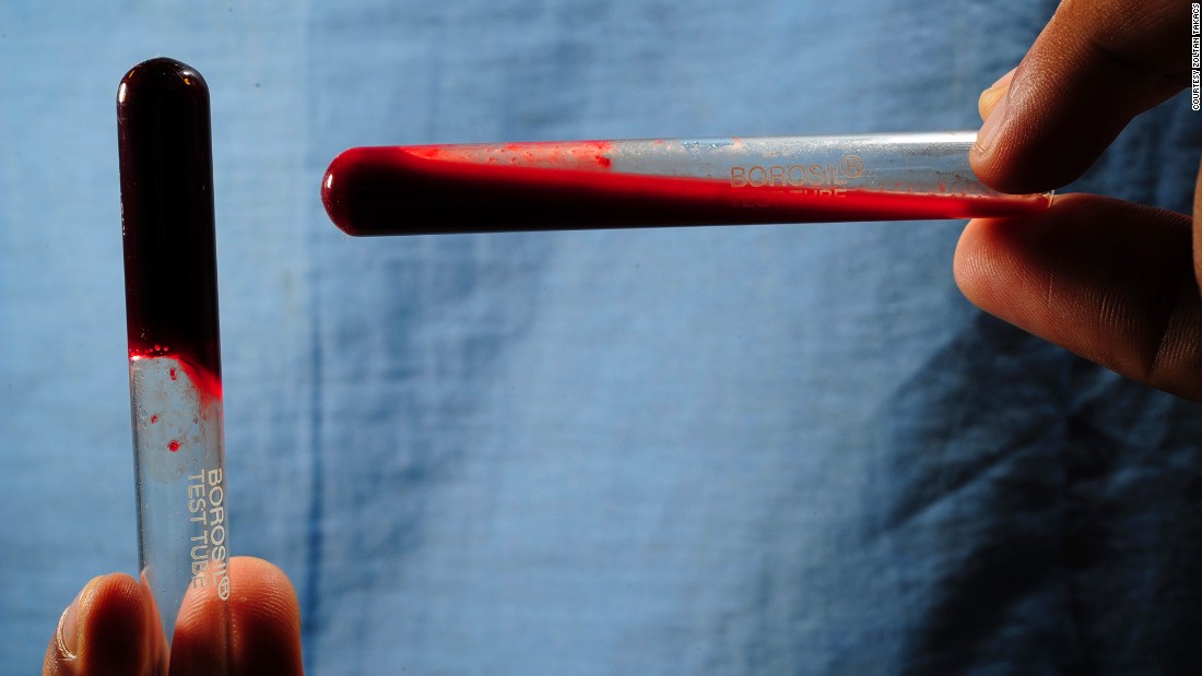 Viper venom prevents blood from clotting, which can be harnessed for anticoagulant drugs. Pictured, left: Blood from a healthy control coagulates after 20 minutes of test time. Right: Bitten by a mountain pit viper, blood from a patient in Nepal remains unclotted after 20 minutes.