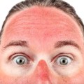 01 gross summer habits sunburn